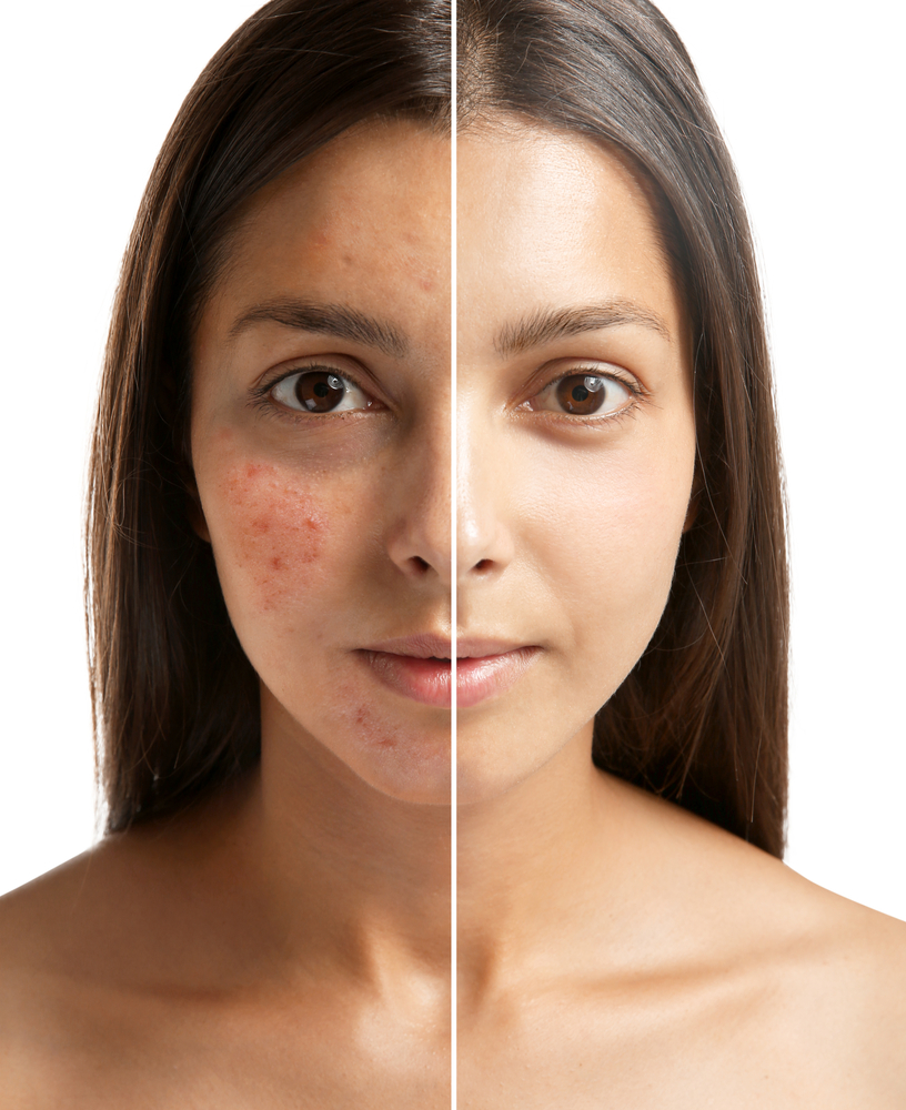 acne dark spots on face